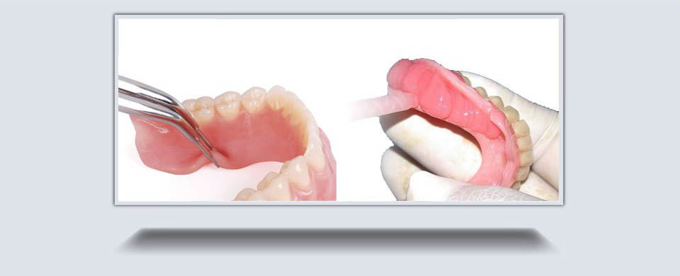 Temporary Soft Liners Hamilton Soft Liners Waterdown Denture Clinic