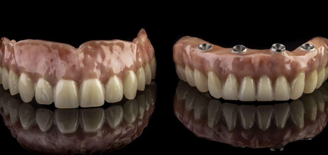 Implant-dentures-22
